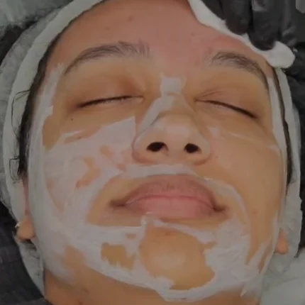 Chemical Peels
